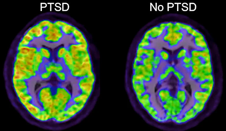 brain scans