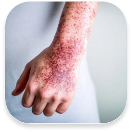 PSORIASIS, DIABETIC ULCERS, PRESSURE ULCERS, AND SKIN PROBLEMS